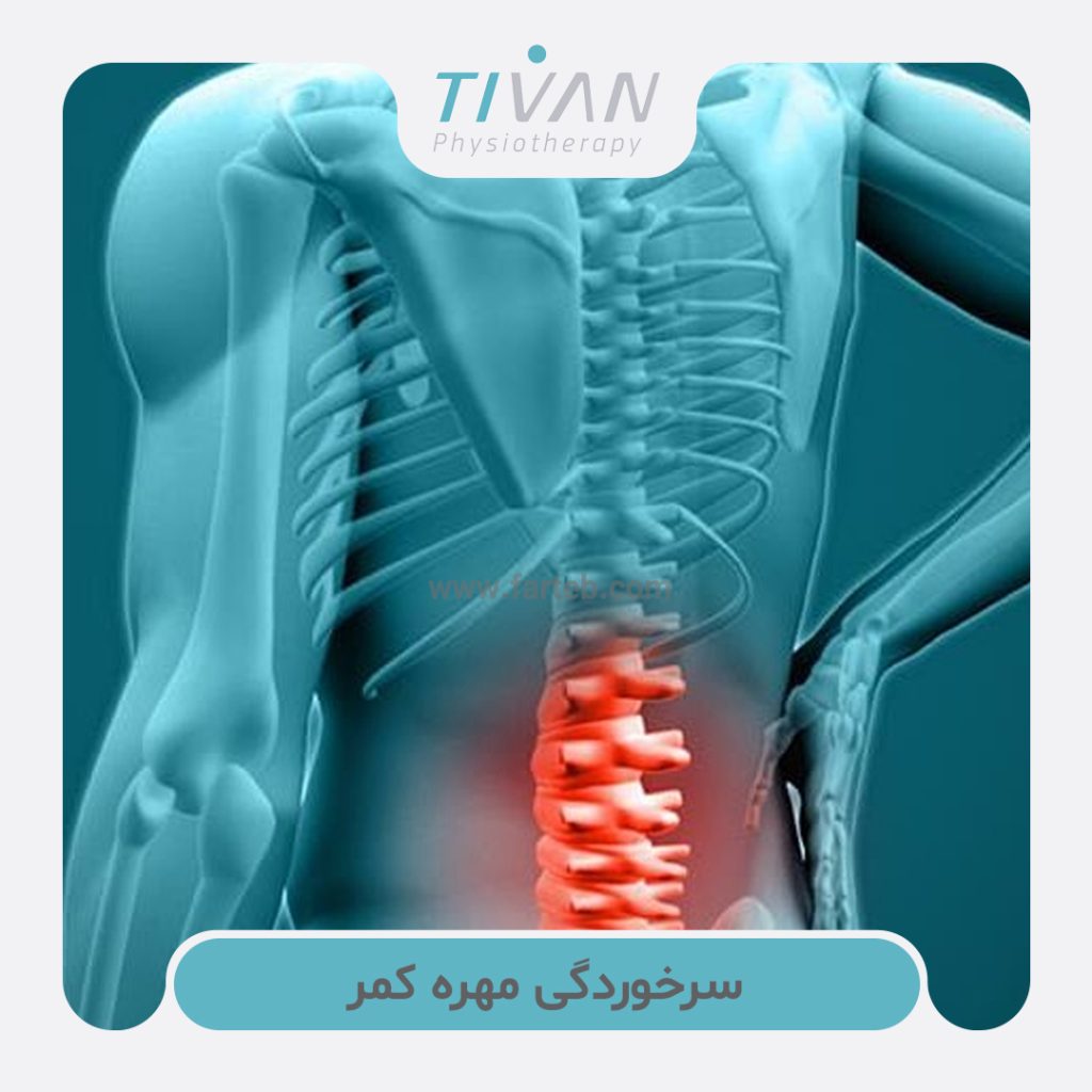 سرخوردگی مهره‌ کمر