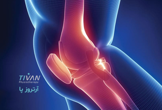 درمان آرتروز پا