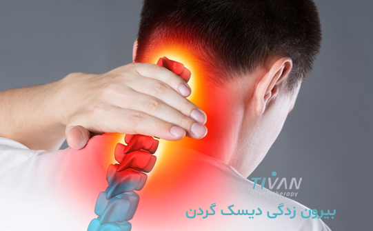 درمان بیرون زدگی دیسک گردن