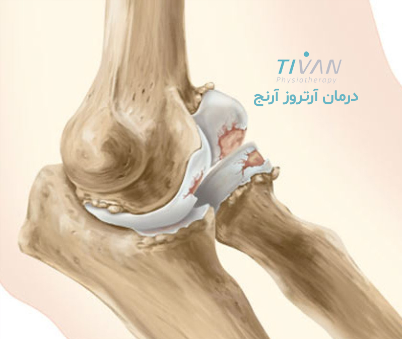 درمان آرتروز آرنج