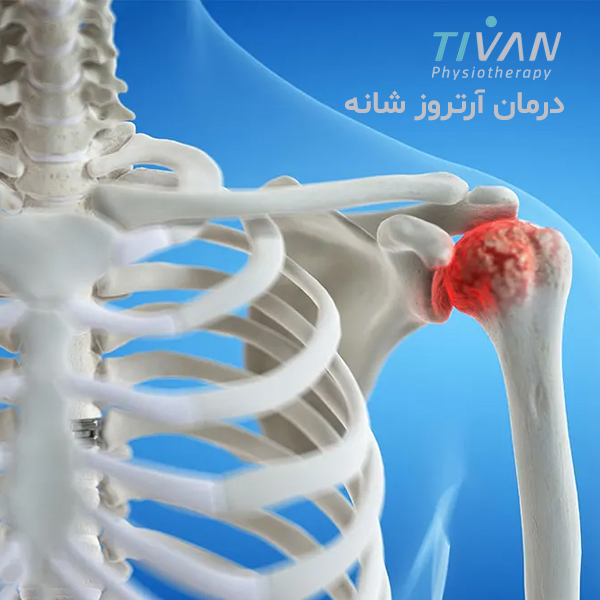 درمان آرتروز شانه