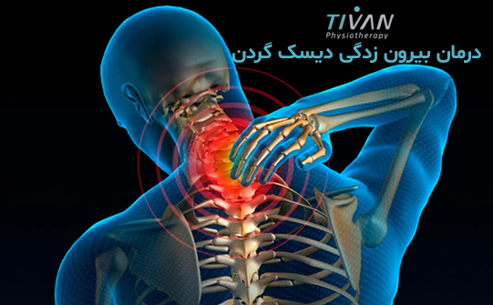 درمان بیرون زدگی دیسک گردن