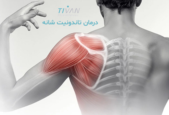 درمان تاندونیت شانه