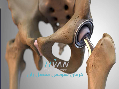 درمان تعویض مفصل ران