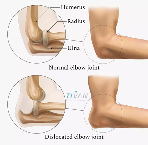درمان در رفتگی مفصل آرنج