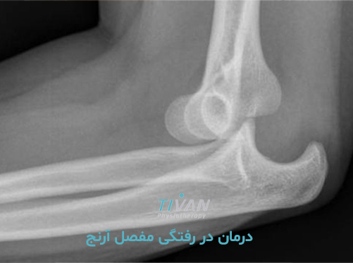 درمان در رفتگی مفصل آرنج