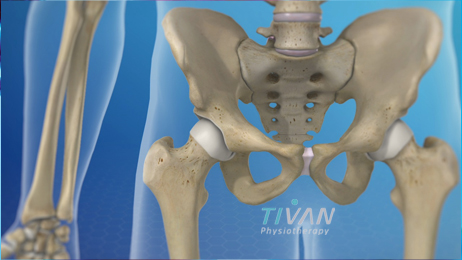 درمان دیسپلازی مفصل ران