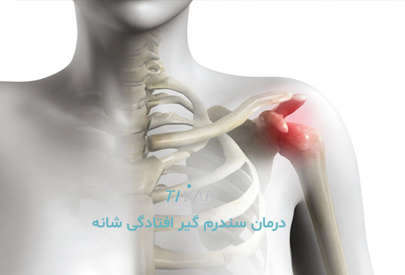 درمان سندرم گیر افتادگی شانه