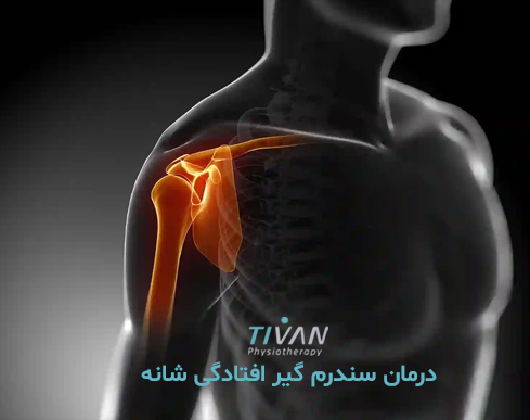 درمان سندرم گیر افتادگی شانه 