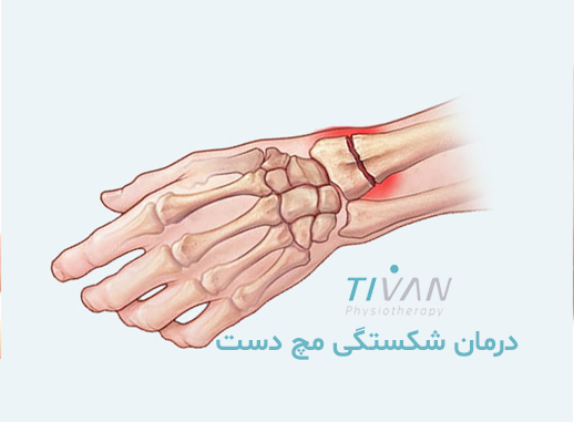 درمان شکستگی مچ دست
