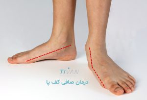 درمان صافی کف پا
