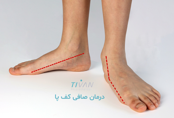 درمان صافی کف پا
