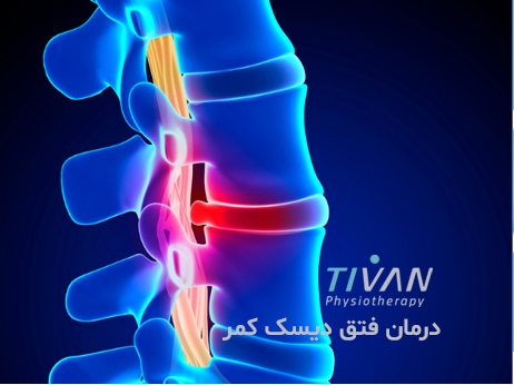 درمان فتق دیسک کمر