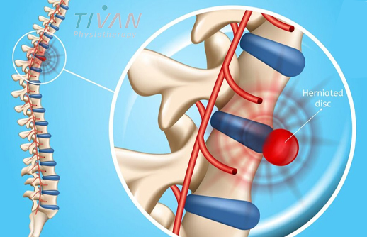 درمان فتق دیسک کمر
