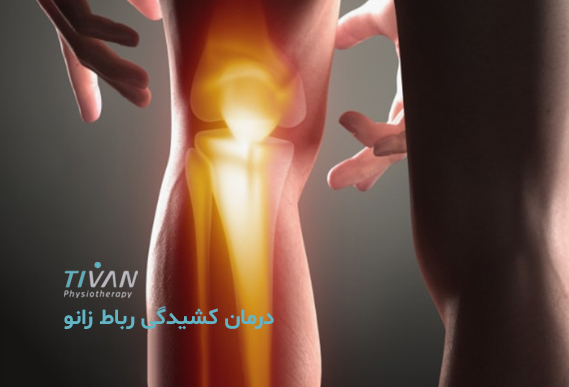 درمان کشیدگی رباط زانو