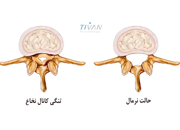 درمان تنگی کانال نخاعی گردن
