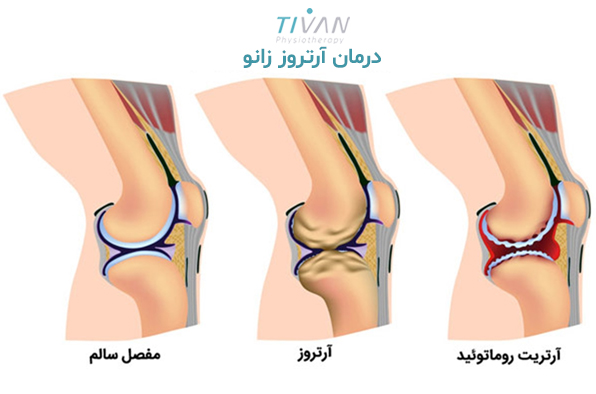 درمان آرتروز زانو