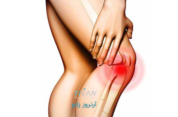 درمان آرتروز زانو