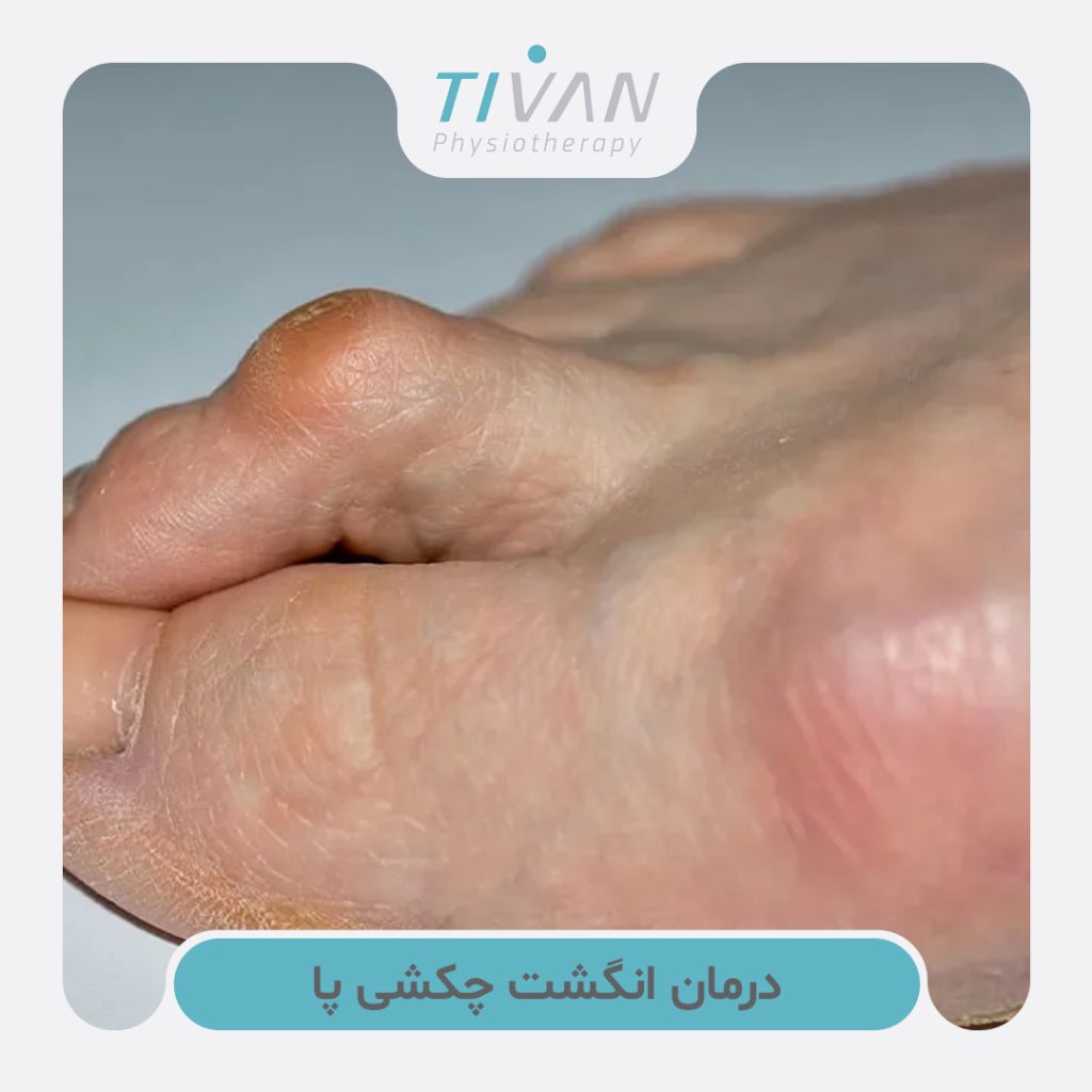 درمان انگشت چکشی پا