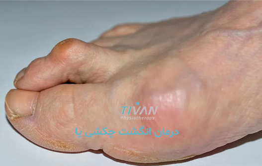 درمان انگشت چکشی پا
