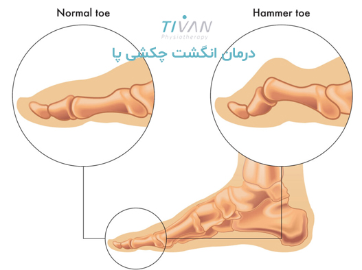 درمان انگشت چکشی پا