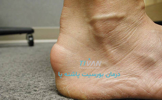 درمان بورسیت پاشنه پا