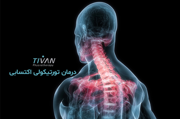درمان تورتیکولی