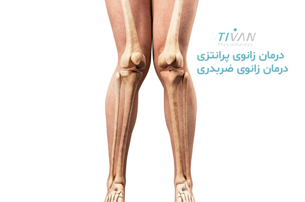 درمان زانوی پرانتزی درمان زانوی ضربدری