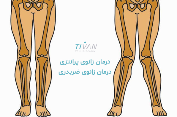 درمان زانوی پرانتزی درمان زانوی ضربدری