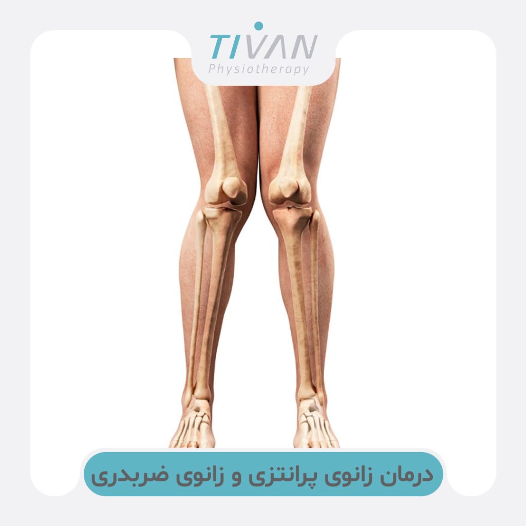 درمان زانوی پرانتزی و زانوی ضربدری