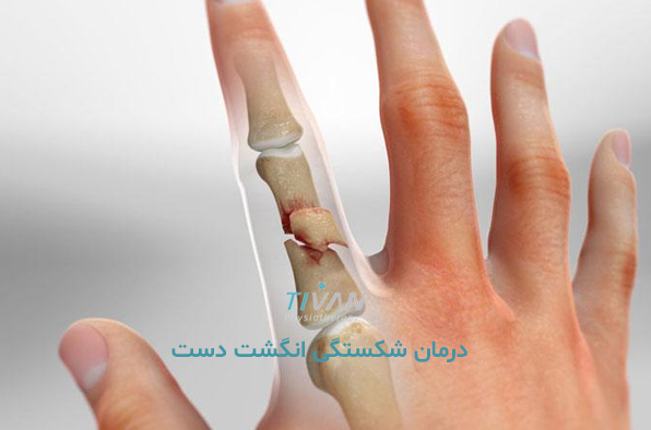 درمان شکستگی انگشت دست