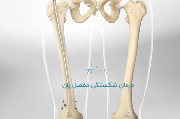 درمان شکستگی مفصل ران