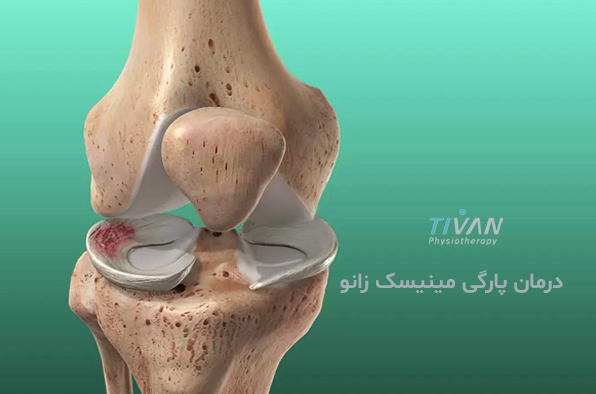 درمان پارگی مینیسک زانو