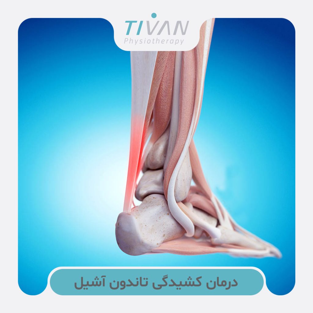 درمان کشیدگی تاندون آشیل