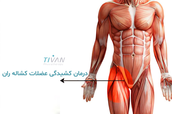 درمان کشیدگی عضلات کشاله ران