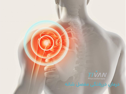درمان دررفتگی مفصل شانه