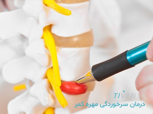 درمان سرخوردگی مهره‌ کمر