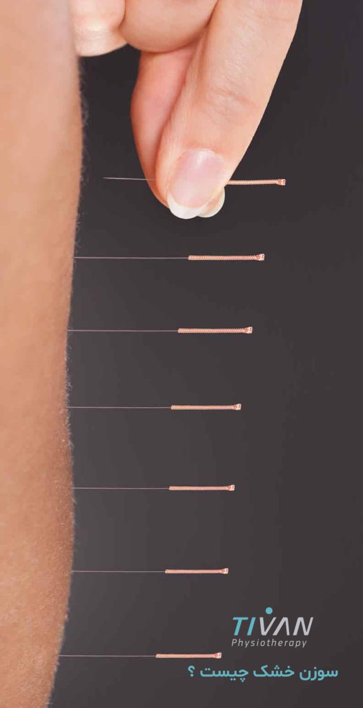 سوزن خشک چیست ؟