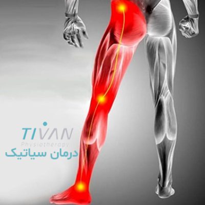 درمان سیاتیک