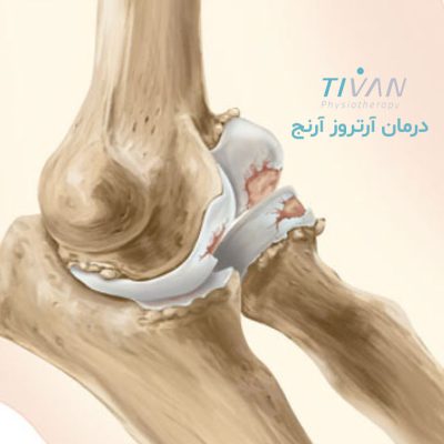 درمان آرتروز آرنج