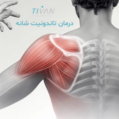 درمان تاندونیت شانه