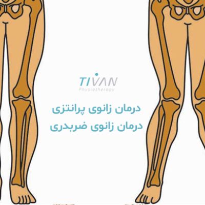 درمان زانوی پرانتزی درمان زانوی ضربدری