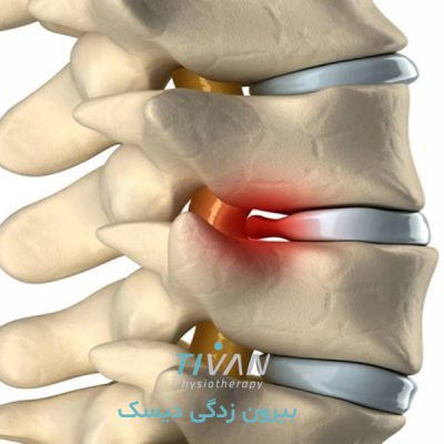 بیرون زدگی دیسک گردن