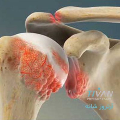 درمان آرترز شانه