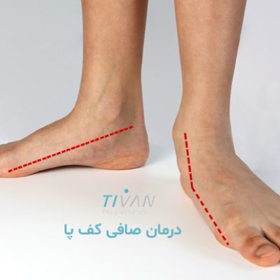 درمان صافی کف پا