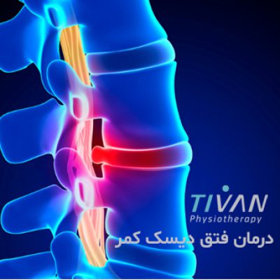 درمان فتق دیسک کمر