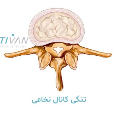 درمان تنگی کانال نخاعی