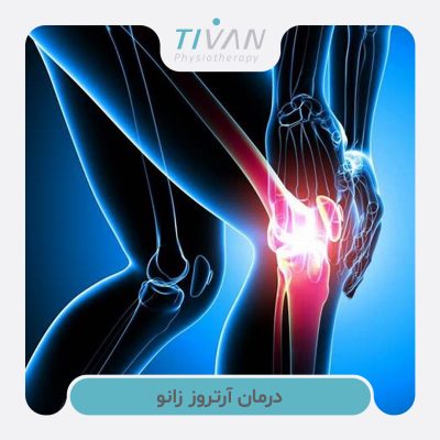 درمان آرتروز زانو