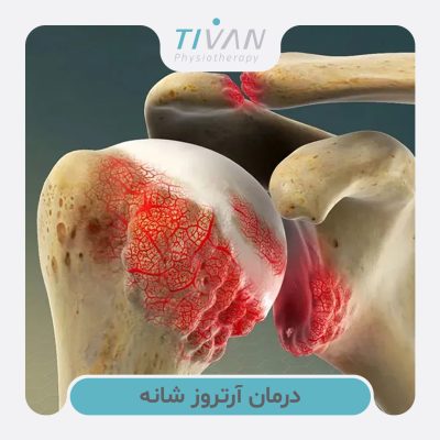 درمان آرتروز شانه