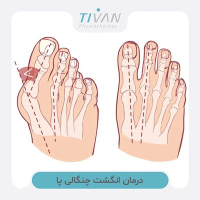 درمان انگشت چنگالی پا